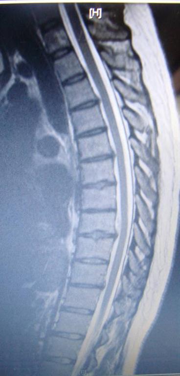 thoracic disc herniation treated by Montreal chiropractor